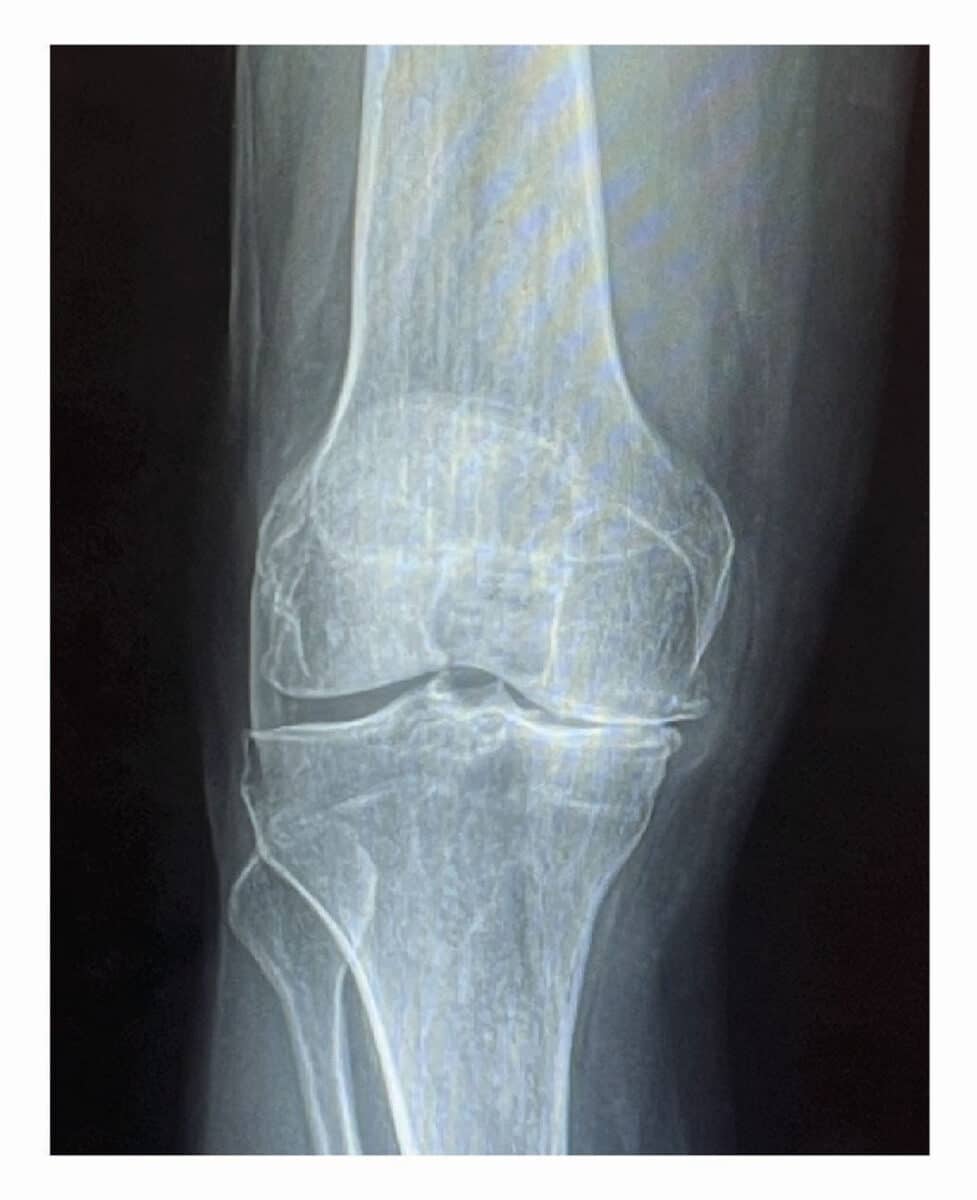 Alameda Post - An xray of a knee with no cartilage on one side. 
